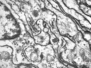 M,55y. | meningotheliomatous meningeoma M,55y. | meningotheliomatous meningeoma